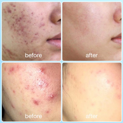 Acne Treatment Gel