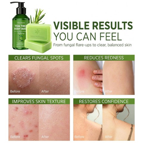Tea Tree Antifungal Skin Care Set