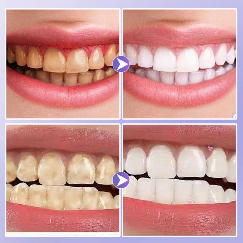 Gloss tooth