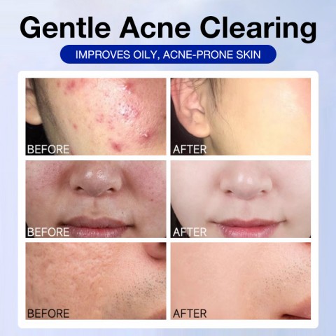 Pimples Removal Cream