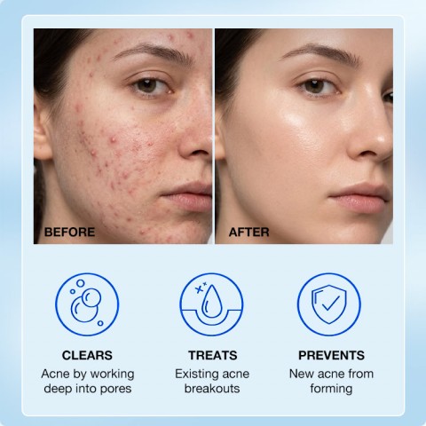 Pimples Removal Cream
