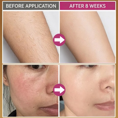 Natural Cyperus Rotundus Hair Removal Oil