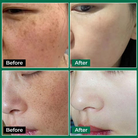 5X Melatoning Ampoule