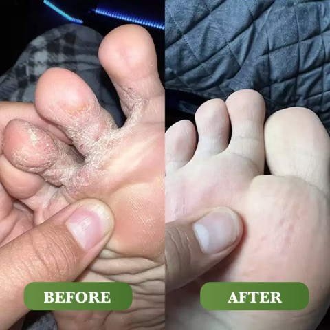 Tea Tree Soap and Foot Cream Foot Treatment Set