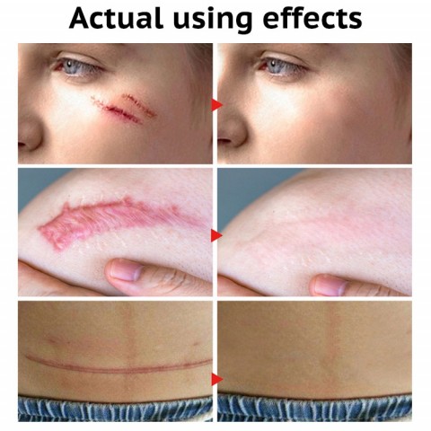 Scar Remover Gel Cream Acne Treatment Whitening Moisturizer Serum Skin Care