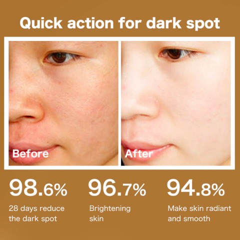 377Vita C serum and cream-Deep whitening, remove melasma, freckles, sunspots, acne Scars, age spots