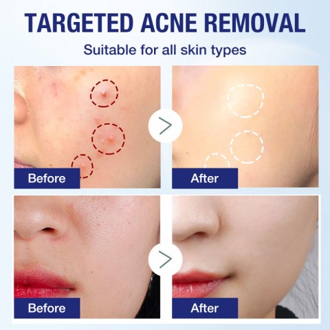 Japanese anti-acne skin care essence