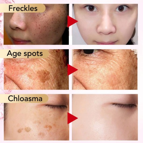 Niacinamide freckle treatment set