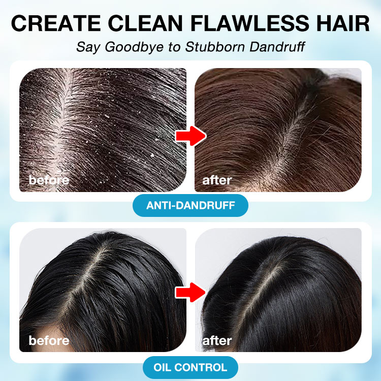 Kadayawan Festival Promo-The second is only 499 pesos-1% Ketoconazole Anti-Dandruff Oil Control Shampoo-Say goodbye to dandruff and hello to confidence