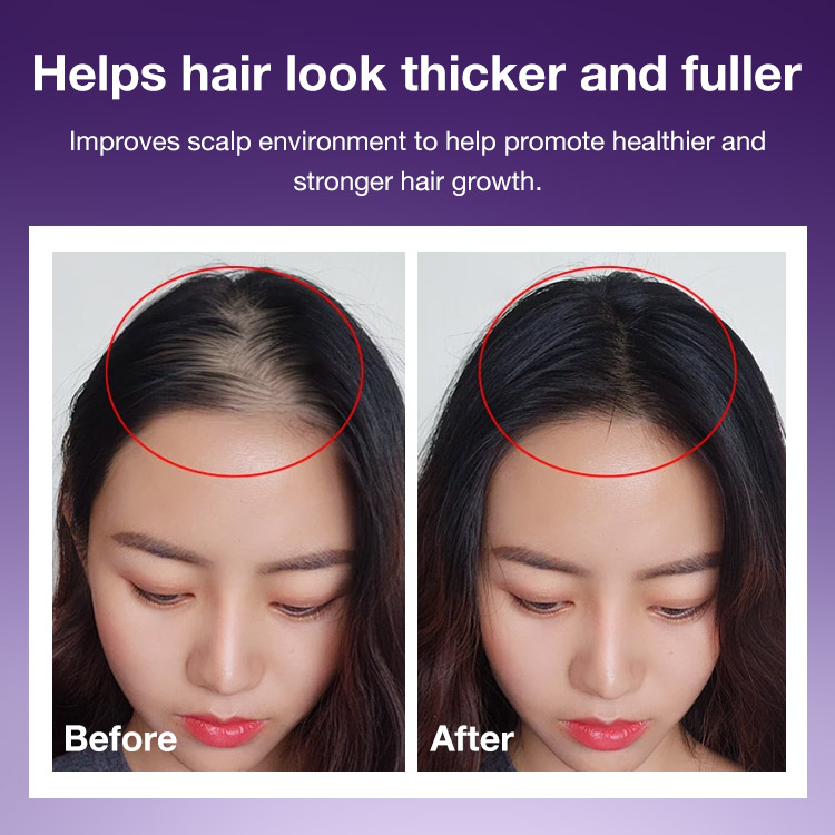 Mid-year Promo Buy 1 Take 1 to Save ₱599 - the No. 1 Korean Hair Thickening Roll-On Serum Reduces Hair Shedding - Targets Thinning Areas- Nourishes the Scalp Support fulle-Perfect for all scalp types
